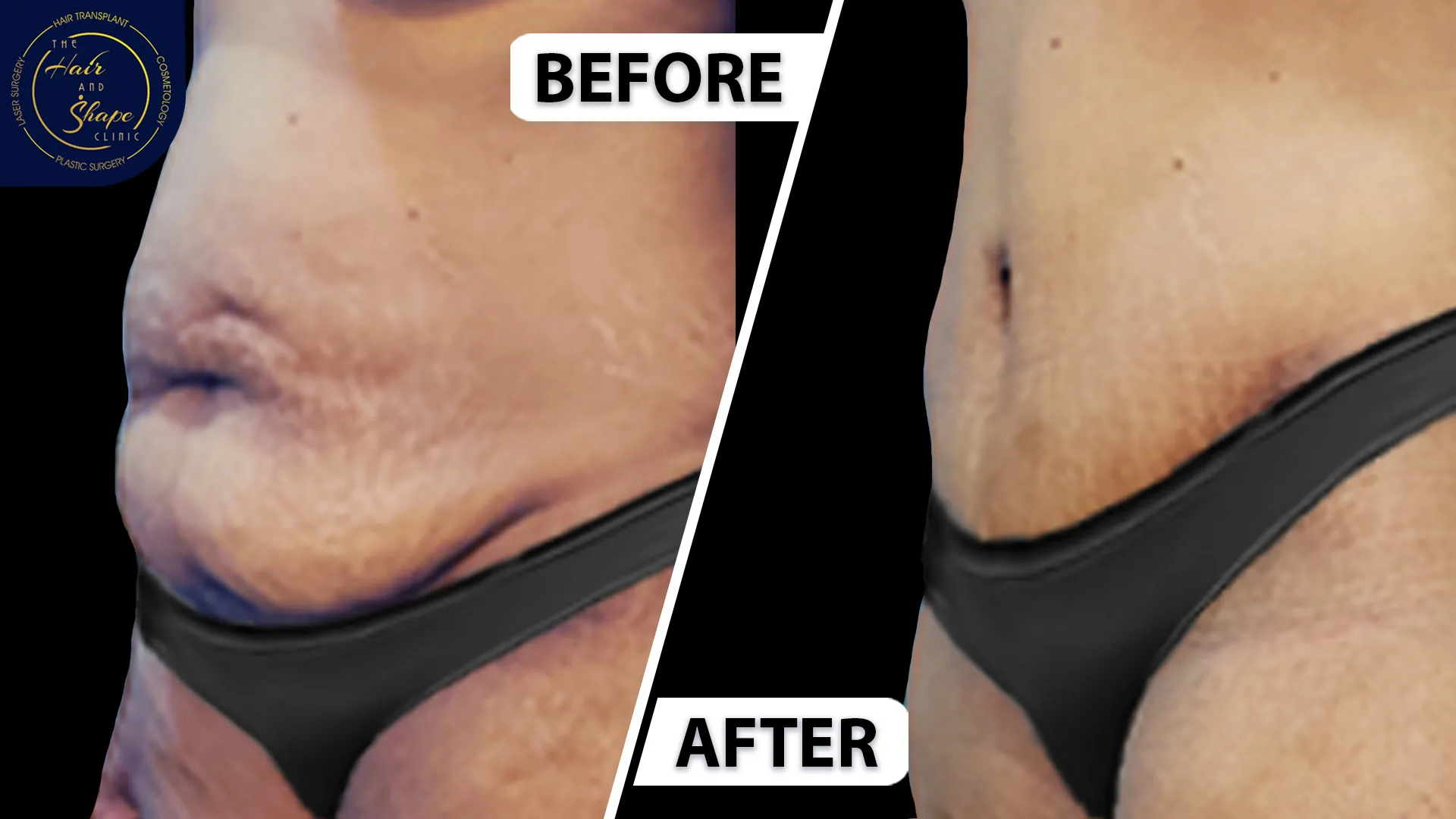 Tummy Tuck result4